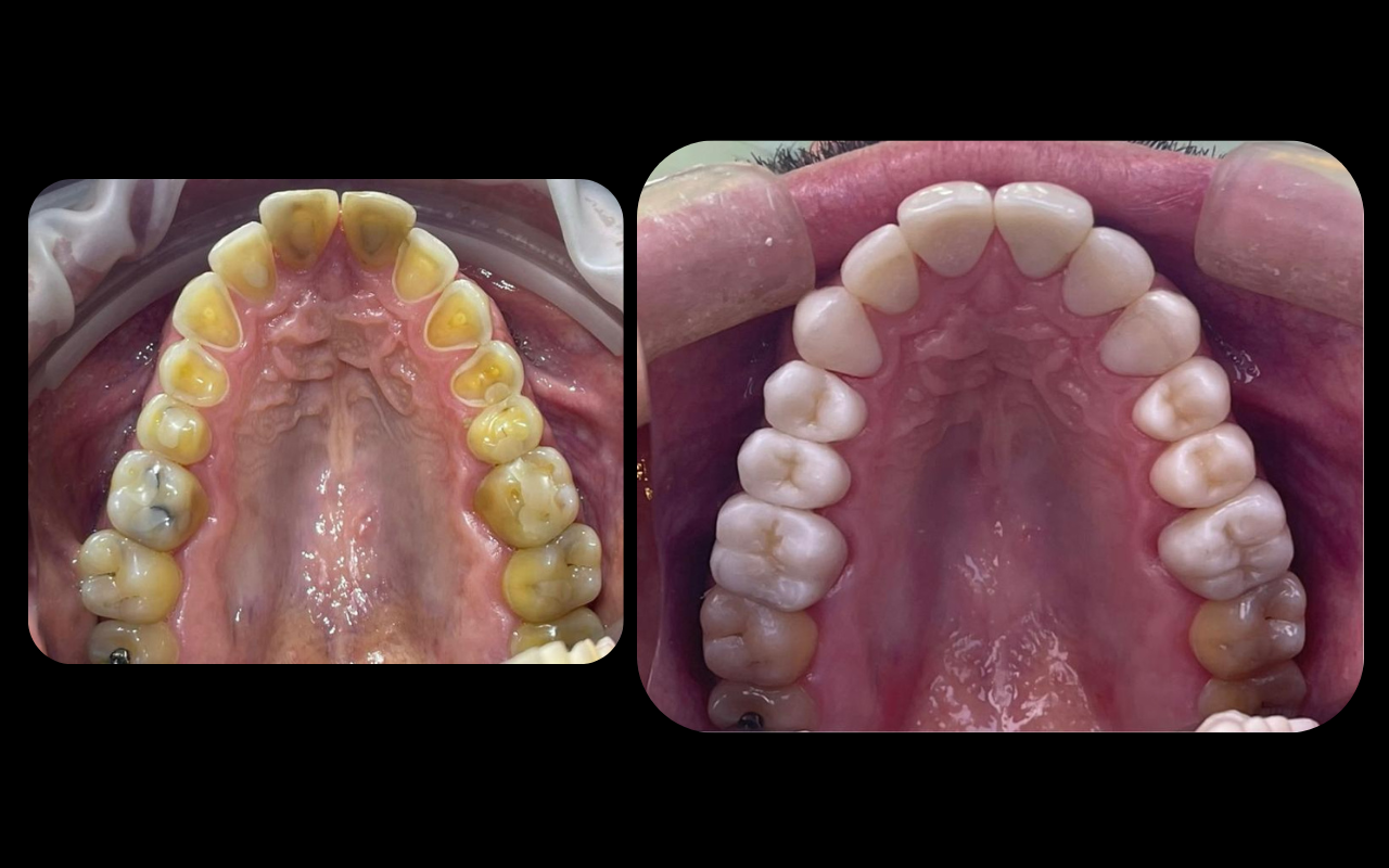 Reabilitação Estética e Oclusal realizada pela Dra. Fabiola Roggia em Porto Alegre